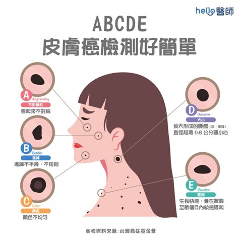 生黑痣|痣形成的原因？痣長毛、痣變多變大是痣病變？5招判。